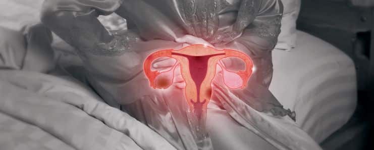 Uterine Fibroids